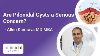 Are Pilonidal Cysts a Serious Concern? | Pilonidal Expert