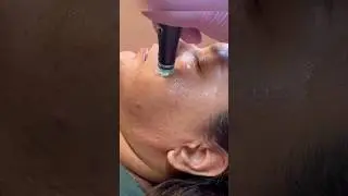 First Facial Treatment #hydrafacial #skincare #hydrafacialglow #acnetreatment #skin
