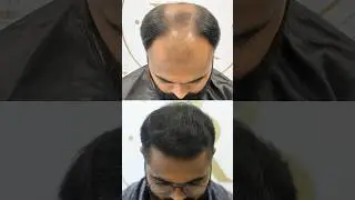 REDO YOURSELF  #hairtransplantcost #newrootshairclinic