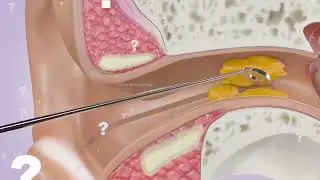 Ear bud injury