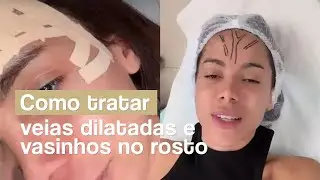 Como tratar veias dilatadas e vasinhos no rosto? Dr. Fabricio Duarte - Angiologista Joinville