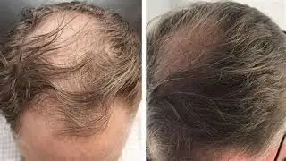 Hair Botox Exosomes and PRP 20 Newage hair fall treatments you need to know about
