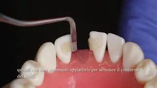 Ribbond Bridge Technique   Italian Audio and Text