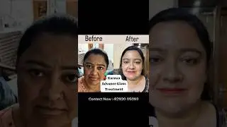 100% result 💓 Korean glass skin treatment 💁#skincare #korea #korean