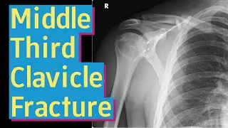Mid Shaft Clavicle Fracture
