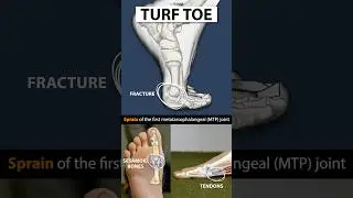 Turf Toe Explained #shorts