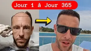🟢Greffe de cheveux : &eacute;volution mois par mois photo pendant 1 an Implants 12 Mois apr&egrave;s [Time-Lapse]