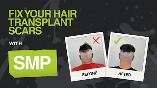 How Scalp Micropigmentation FIXES Hair Transplant Scars! (Examples Included)