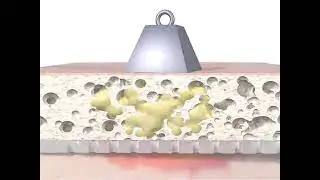 Allevyn adhesive -  Hydrocellular adhesive dressing for the treatment of exudative wounds