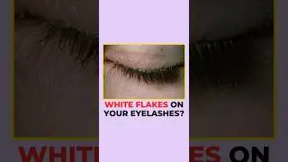 Itchy Eyes & White Flakes on Eyelashes? | Eye Doctor Reveals the Hidden Causes  #shorts