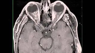 Optic Neuritis
