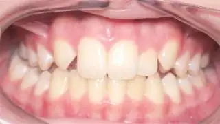 Canine Substitution (Missing Lateral Incisor): Kyger Orthodontics