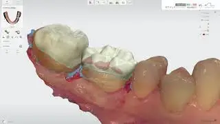 cerasmart onlays with Trios 3 scanner