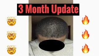 Asli Tarcan | African American | Hair Transplant | 3 Month Update