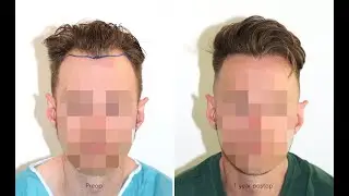 FUE Haartransplantation Geheimratsecken und Haarlinie |&nbsp;1933 FUs |&nbsp;Dr. Feriduni