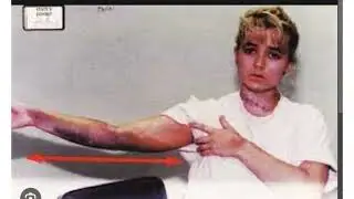 The Magic Disappearing Bruising on Darlies Arms