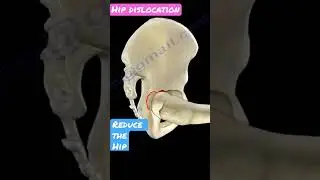 Hip dislocation #shorts