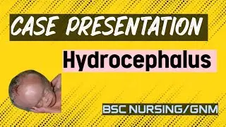 case presentation on hydrocephalus/ case study on hydrocephalus #hydrocephalus