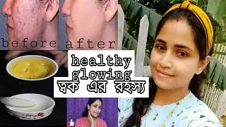 get problem free healthy skin ✨ skin care bengali 🌿 monsoon skin care remedy