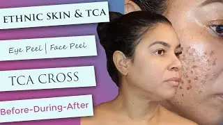 Ethnic Skin TCA Peel | CROSS   Before/During/After  | Eye Peel