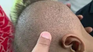 Woolly hair