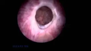 New staging system for anterior strictures