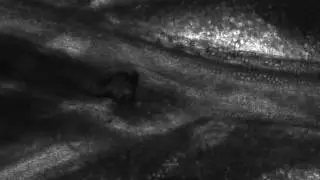 S. Mansoni Worm in Mesenteric Veins
