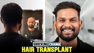 Grade 4 Hair Transplant Result | 3500 Grafts BIG-FUE | Hairfree & Hairgrow Nagpur