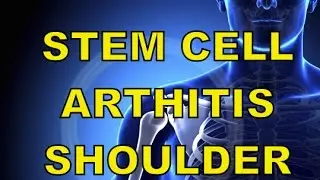 Stem Cell Therapy for Shoulder Pain avoid surgery with 90% success rate!