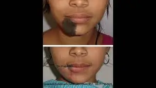 Birthmark Removal Before After n Cost,  Delhi,  India