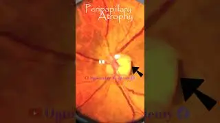 Peripapillary Atrophy | Diabetic retinopathy | Fundus | Short Video 353