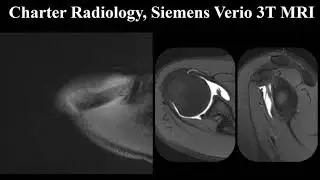 MRI Arthrogram of the Shoulder
