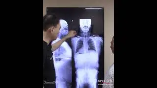 40 Years of Chronic Migraine With Aura - FIXED After This Gonstead Adjustment #short