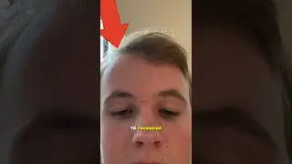 I Started Balding AT 16 but got over it