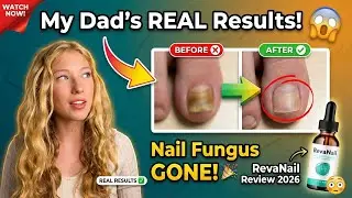 RevaNail Review ⚠️ My Dad's Nail Fungus Nightmare (Before & After SHOCKING) 😱