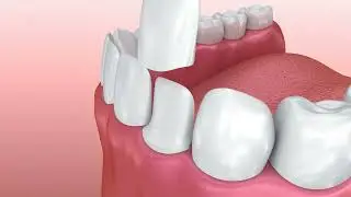 Porcelain Veneers | Teeth Veneers Smile Makeover | Fort Bend Dental | Missouri City, Richmond TX