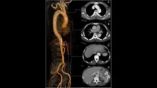 GE ADW AORTOGRAM POST-PROCESSING