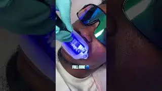 crazy teeth whitening results 😱😳🦷 #teethwhitening #teethwhiteningtech