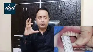 mouth opening problem n it's solutions ! (osmf ka ilaj)