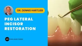 Peg Lateral Incisor Restoration
