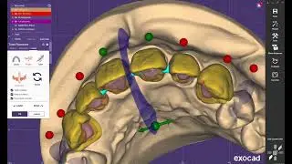 High-End Aesthetic Tooth Setup | Digital Dental Modeling