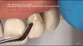Class V composite restoration on a maxillary lateral incisor (#22) - Arabic عربي