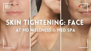 Non-Surgical Facial Skin Tightening at MD Wellness Center, Indianapolis