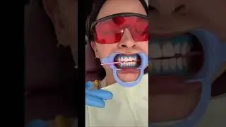How do you open your clients bite? #teethwhitening #dentist #dental #mentor #coach #teeth