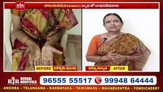 #psoriasis problem /📍RJR Herbal Hospitals / 6 States / 102+ Branches / 300+ Doctors