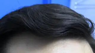 Hair Transplant Before and After Surgery Dr Hasson