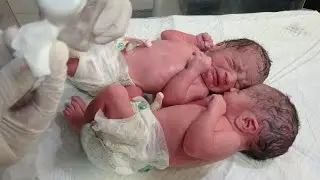 Twins Newborn Baby Care | Umbilical Cord Care, Suction & Emergency Care in NICU