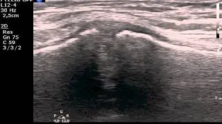 Manubriosternal joint MSKUS ultrasound