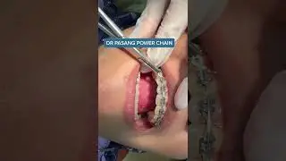 Braces power chain - To apply more force to your mouth to close gaps & align teeth