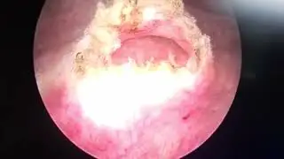 Ureterocele!! #urologytreatment #scarlesssurgery #endoscopicsurgery